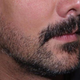 Illustration for article titled Hipster Beard Transplants Are All the Rage These Days